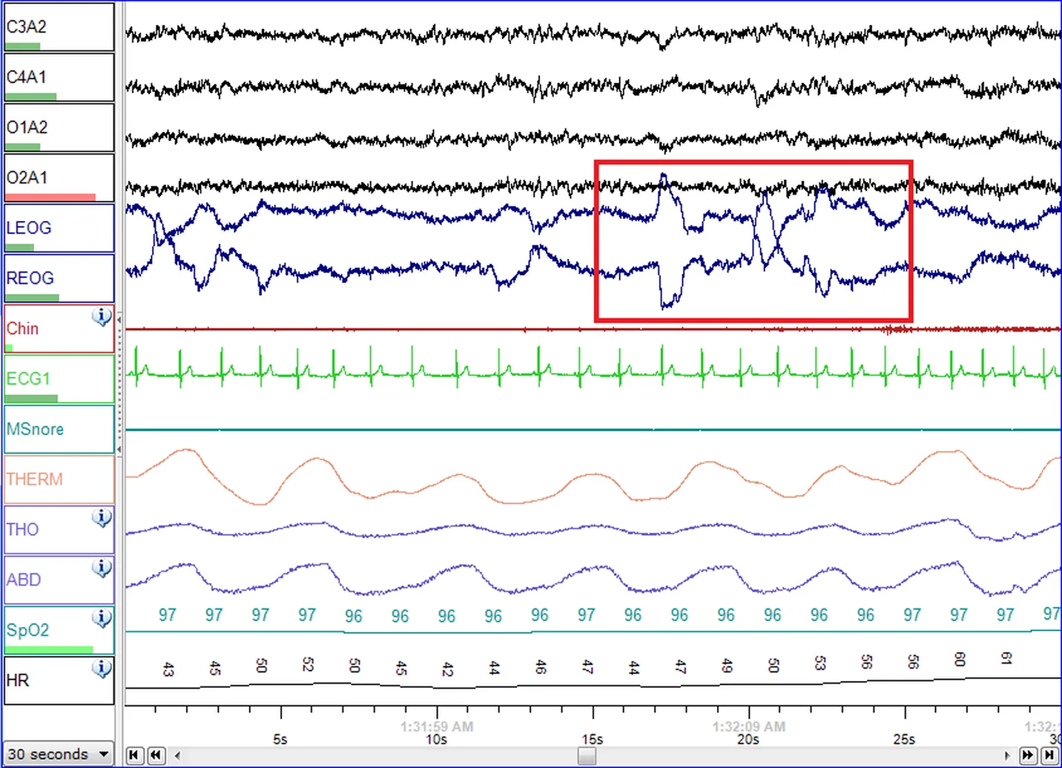 Polysomnography traces showing eye-movement channels during a recorded REM sleep segment, outlined in red.