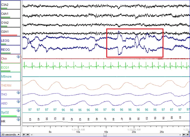 Polysomnography traces showing eye-movement channels during a recorded REM sleep segment, outlined in red.
